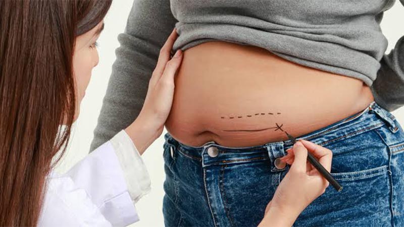 بهترین جراح ابدومینوپلاستی در ونک | دکتر علی سعادتی