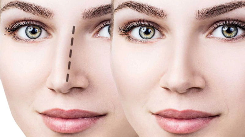 عمل بینی استخوانی | اصلاح قوز و فرم بینی