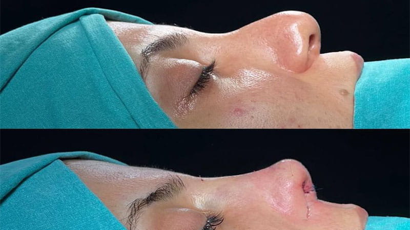 عمل بینی گوشتی در ونک | جراحی بینی گوشتی و نتیجه عمل