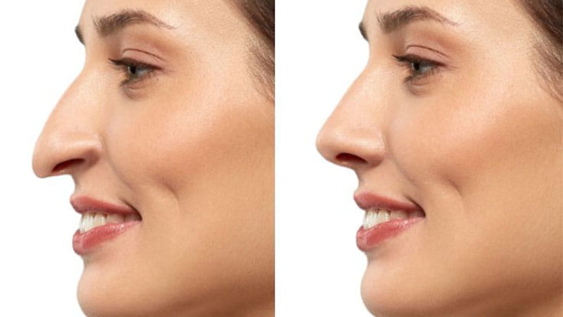 بهترین جراح بینی در ونک | دکتر علی سعادتی
