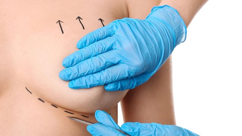 لیفت سینه | جراحی بالا کشیدن و فرم‌ دهی سینه